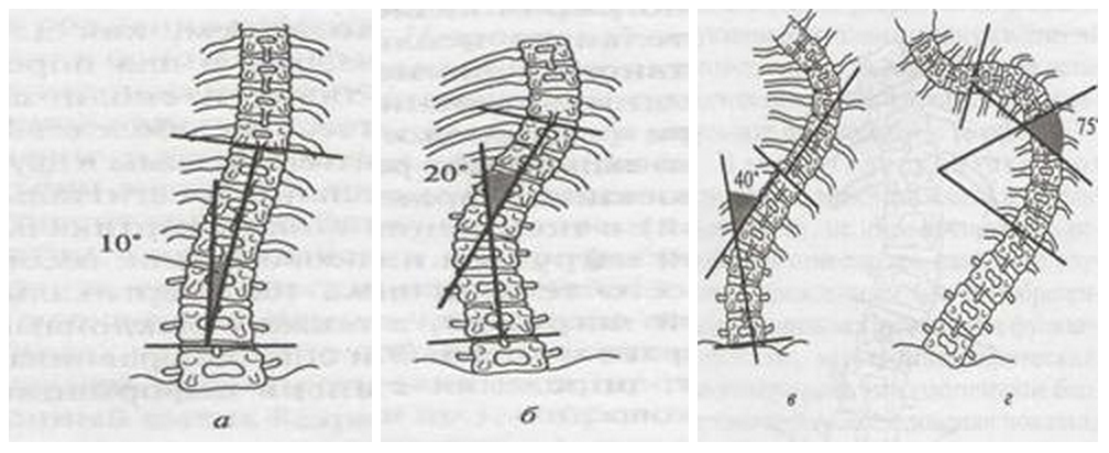 Степени искривления позвоночника