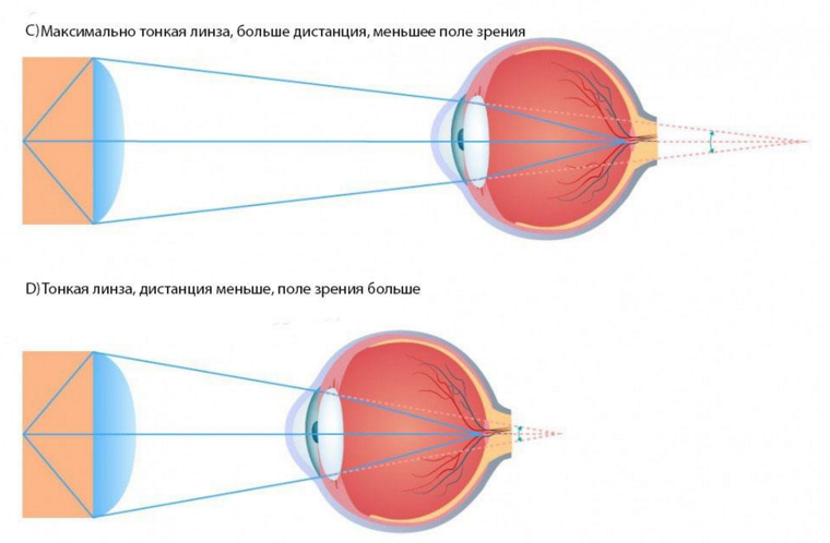 Искривление зрения