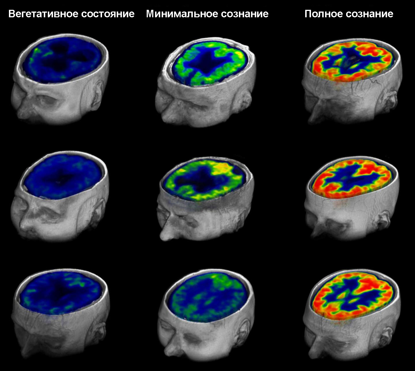 Простой тест показывает, выйдет пациент из комы или нет - 1