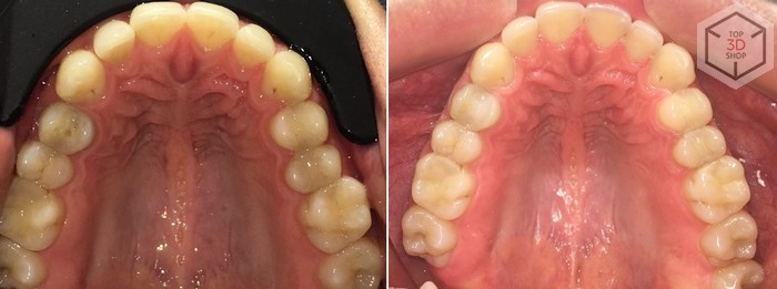Как мы тестировали исправление прикуса элайнерами на нашем директоре - 37