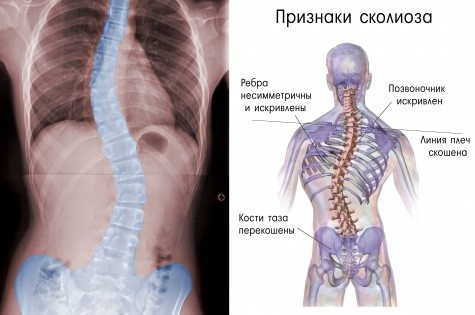 Сколиоз vs Школа: что следует помнить про сколиоз - 4