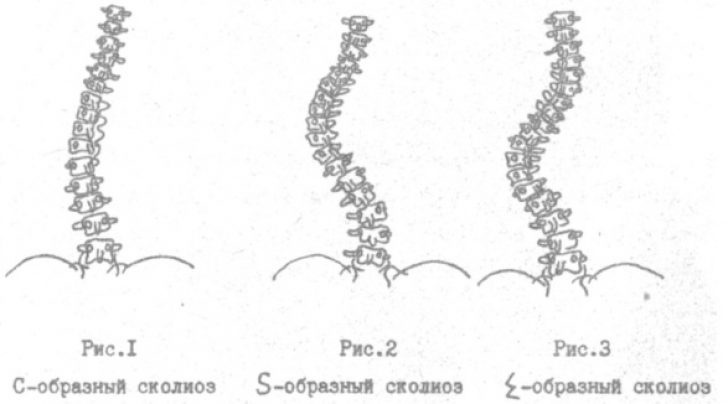 Сколиоз vs Школа: что следует помнить про сколиоз - 5