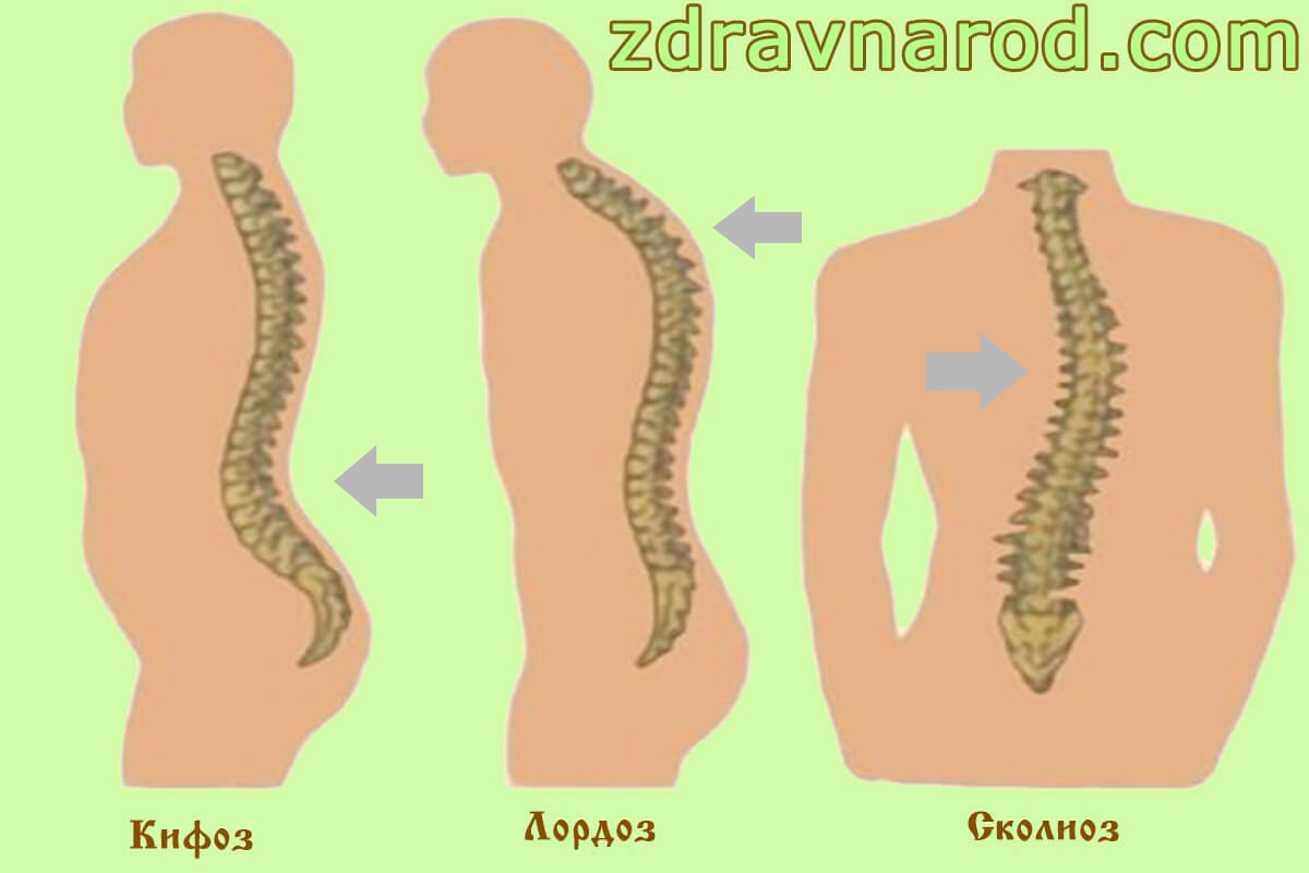 Кифоз лордоз сколиоз фото