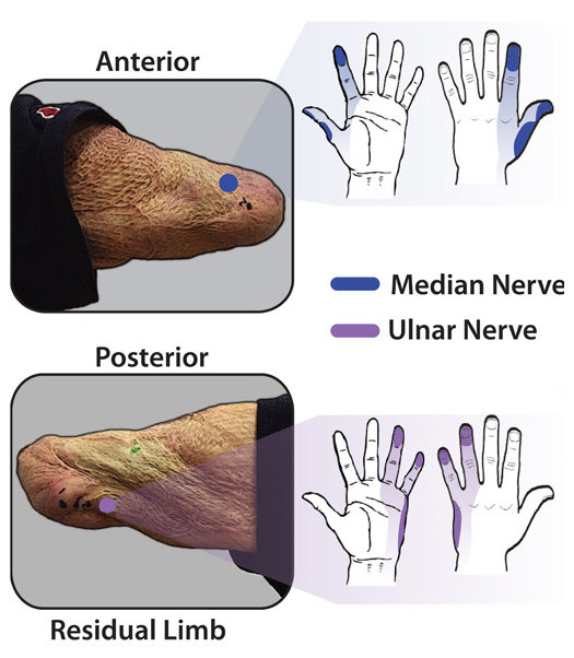 Как заставить протез передавать ощущения: электронная кожа