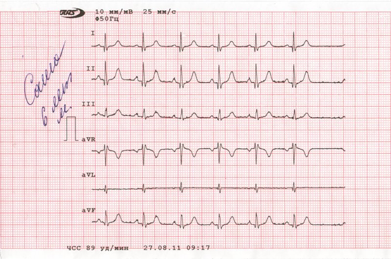 Экг 6. ЭКГ сердца. Кардиограмма сердца здорового человека. ЭКГ нормального человека. Хорошее ЭКГ.