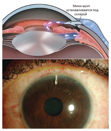 Глаукома операция. Факотопическая глаукома. Дренаж Глаутекс при глаукоме. Экспресс дренаж глаукома.