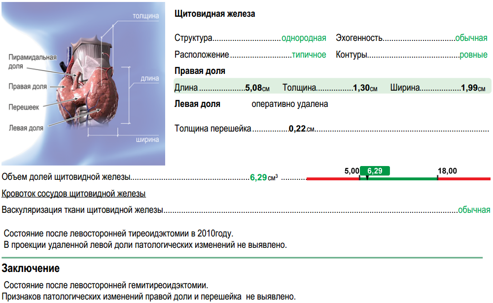 Перешеек щитовидной железы. Толщина перешейка щитовидной железы 2мм. Перешеек щитовидной железы норма. Правая доля щитовидной железы. Норма толщины перешейка щитовидной.