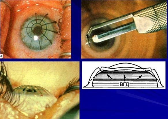 Радиальная кератотомия (насечки на роговице)