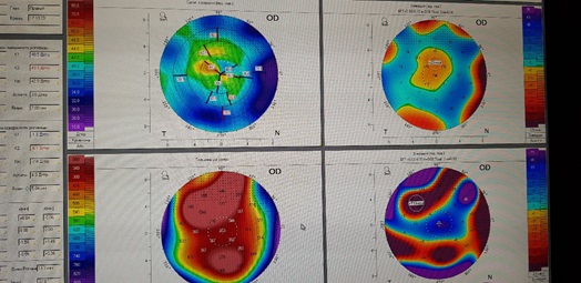 Кератотопограмма роговицы глаза