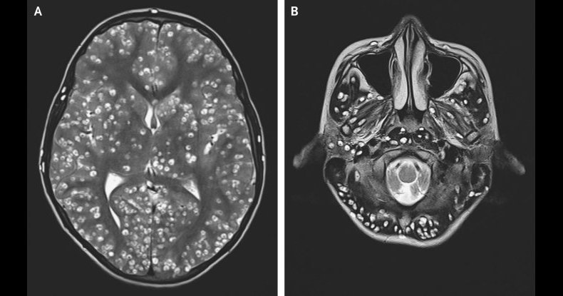 Мозг пациента оказался усеян личинками паразитов