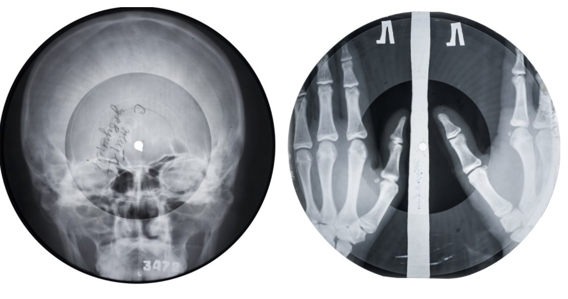 Записано на костях. Пластинки на рентгеновских снимках. Пластинки из рентгеновских снимков СССР. Пластинки на костях. Пластинка на рентгеновском снимке.