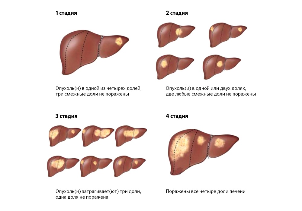 Рак печени картинки
