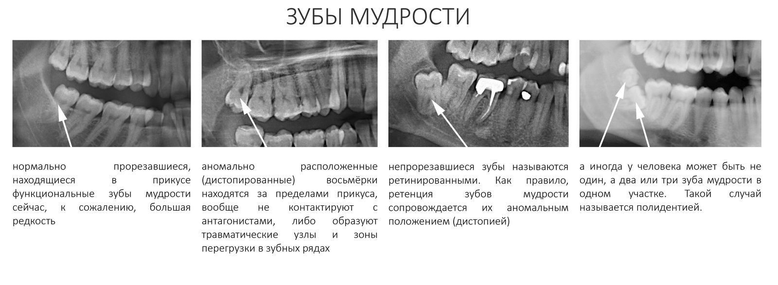 Нижняя восьмерка. Зуб мудрости растет снизу. Удалили 8 зуб снизу мудрости. Как растет зуб мудрости снизу.