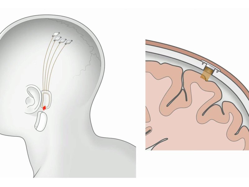 Neuralink: нейроинтерфейс для чтения мыслей и управления компьютерами