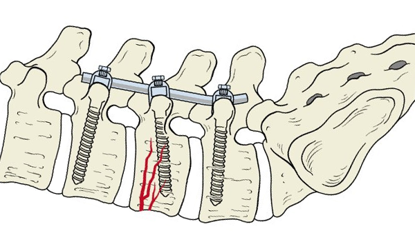 Фиксация позвоночника. Транспедикулярная фиксация позвоночника техника. Транспедикулярная фиксация при переломе позвоночника. Транспедикулярная фиксация позвоночника винты. Схема винтов при транспедикулярной фиксации позвоночника.