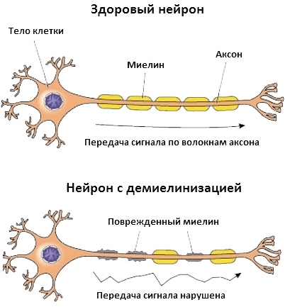 изображение поврежденной миелиновой оболочки аксона и здоровой