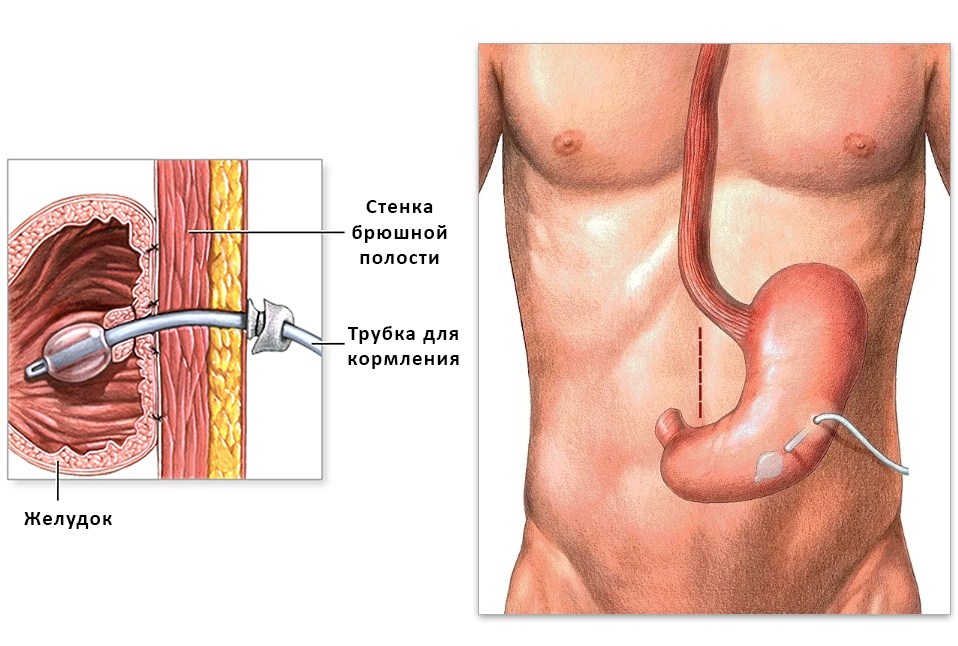 Гастростома это. Гастростома свищ желудка. Строение трубки гастростомы. Эндоскопическая гастростома. Трубчатая гастростома.