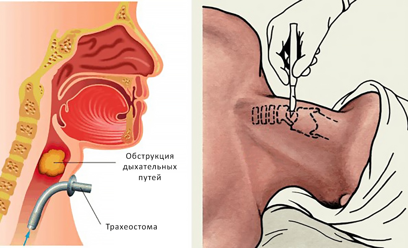 Ивл через трахеостому. Трахеостомия трубка дыхательная. Трубка в горле для дыхания.