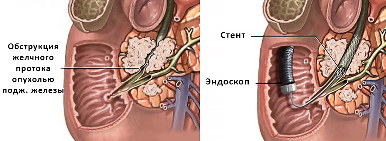 Биопсия поджелудочной железы. Стентирование холедоха желчного протока. Стентирование панкреатического протока. Билиодуоденальное стентирование. Эндоскопическое стентирование желчных ходов.