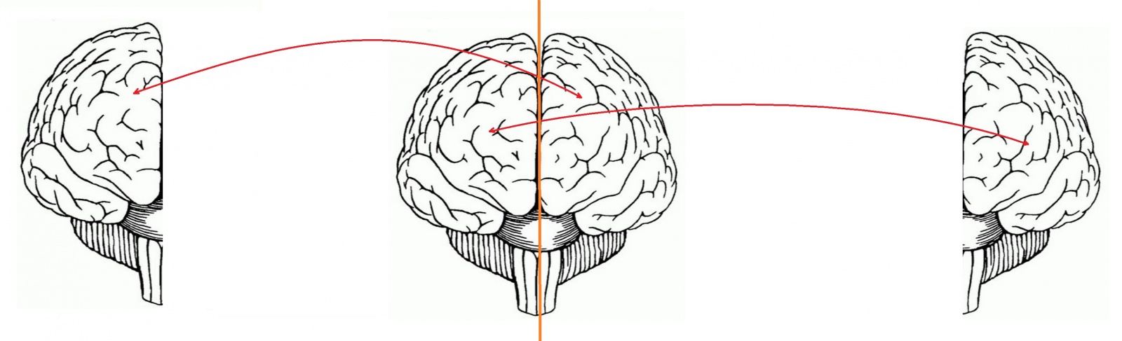 Мозги левы. Операции по разделению полушарий. Операция по разделению полушарий мозга. Перенос сознания. Купол мозгового полушария.