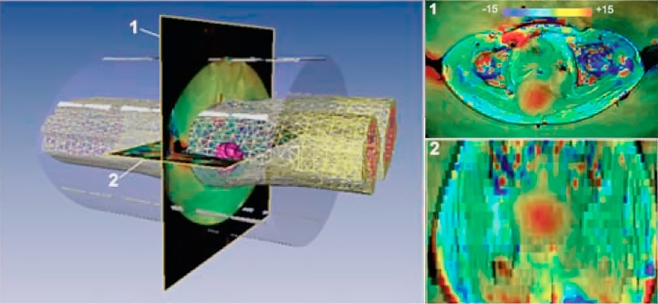Цифровой двойник тела пациента создаётся в виде тетраэдальной меш-сетки, которая используется для решения уравнений Максвелла и последующего расчета области фокусировки электромагнитной энергии. Примеры термометрии с нагревом опухоли до 30 градусов в двух срезах показаны справа. Обратите внимание что есть участки перегрева и вне опухоли.