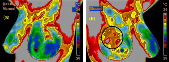Изображения с тепловизора левой и правой молочных желез пациентки с раком груди. Опухоль может быть обнаружена благодаря локально повышенной температуре кожи в районе новообразования. Стоит, однако, отметить, что такой метод не очень точен, потому не заменяет применяемую сегодня массово процедуру маммографии.