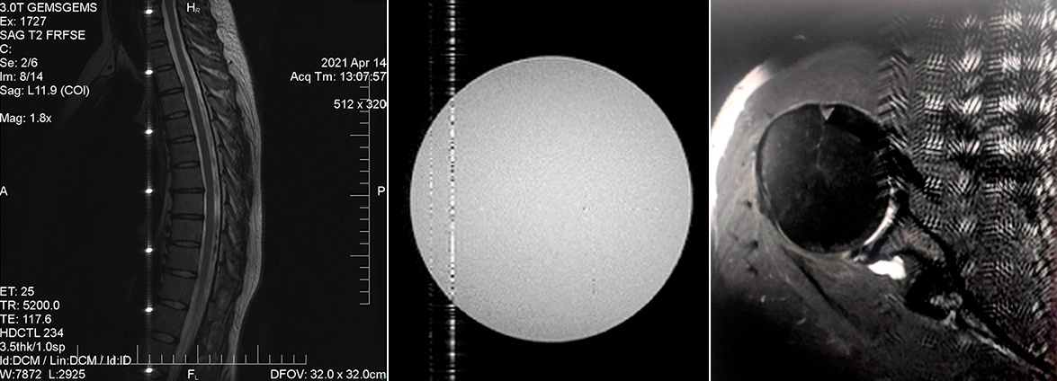 Пример влияния внешних сигналов на изображения в МРТ. Слева снова позвоночник, но с другого ракурса. По центру - сферический сосуд с жидкостью (т.н. фантом). Думаю, довольно очевидно, где же тут помехи. На практике таких полос, звёздочек и белых точек может быть и больше и они могут попадать в любую часть изображения. Справа показан совсем экзотический случай - изображение плечевого сустава на которое наложилась помеха от работы другого аппарата МРТ по соседству.