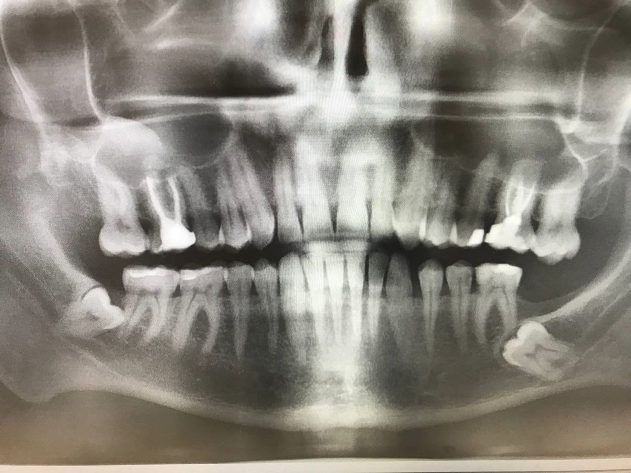 фото вырванных зубов мудрости