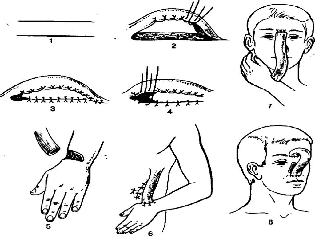 Кожная пластика кожным лоскутом. Операцию «Филатовский стебель». Пластика кожи полнослойным кожным лоскутом. Кожная пластика Джанелидзе. Метод Джанелидзе кожная пластика.