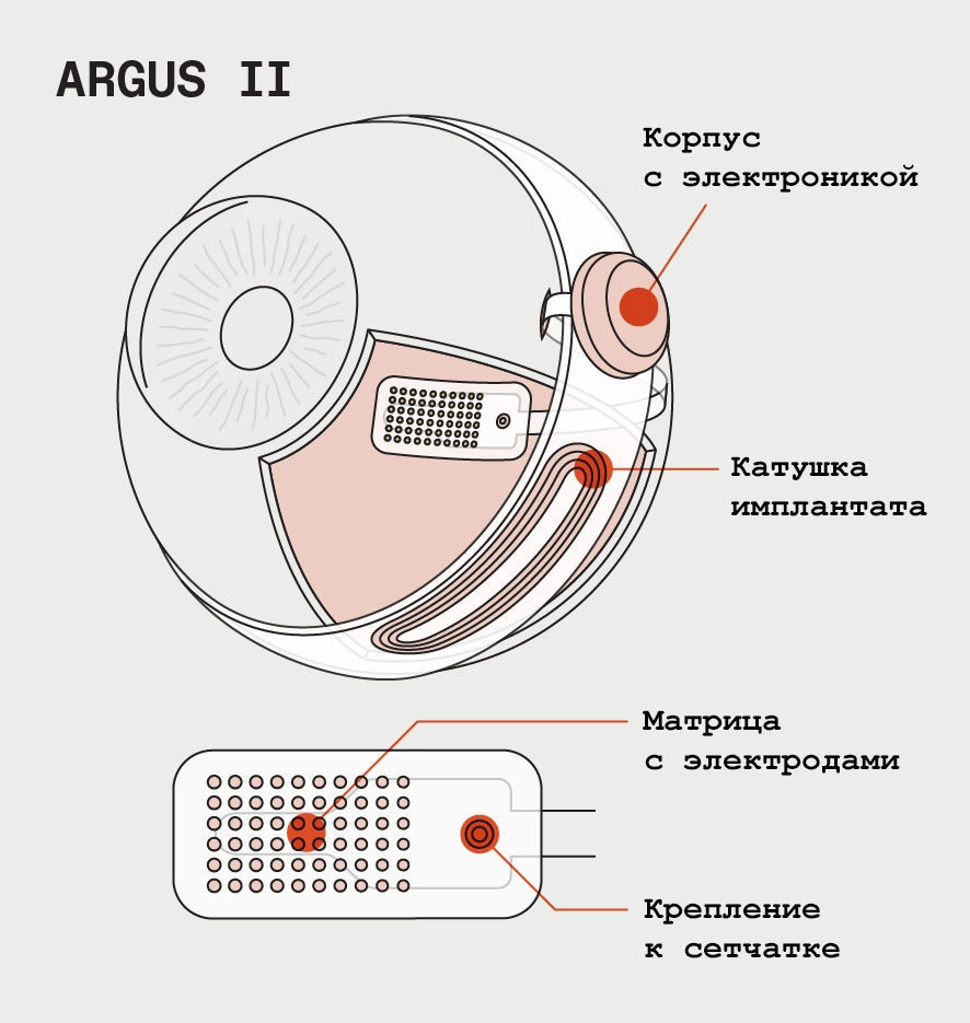 Кибернетические глаза — реальность? ARGUS-II, или второе зрение - 8