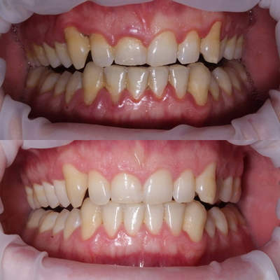 Про стоматологический лазер для зубов (быстро и чисто, но не работает) - 3