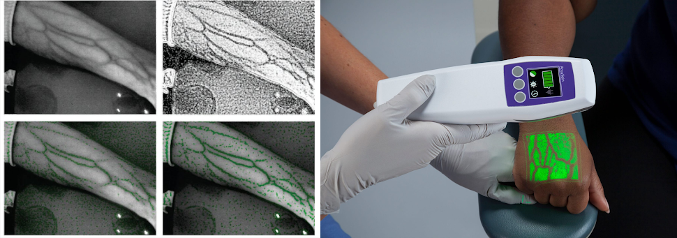Слева сверху: изображение руки полученной камерой со снятым ИК фильтром при освещении светодиодами с различными длинами волн в ближнем инфракрасном диапазоне. На остальных картинках процесс работы алгоритма для определения вен. Источник. Справа: устройство для визуализации вен. Источник.