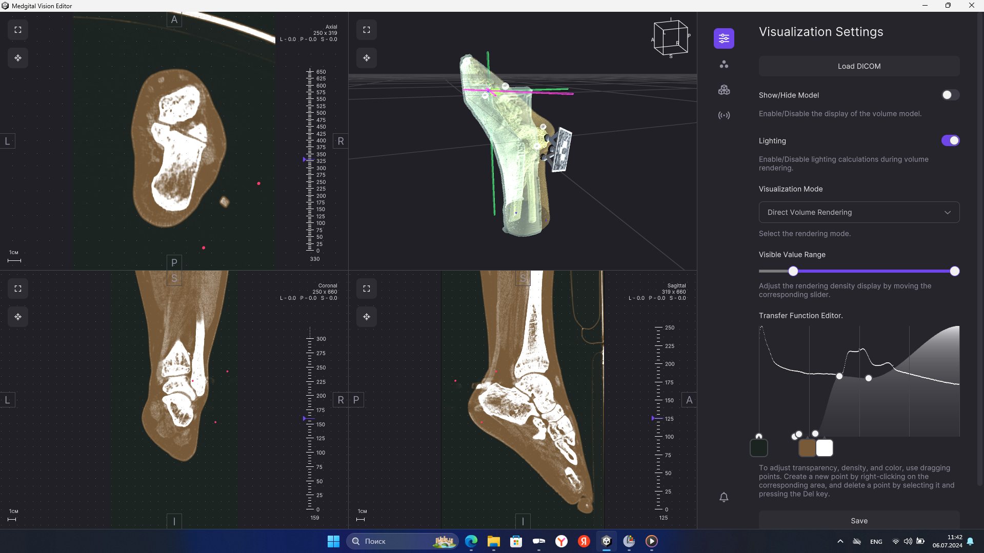 Окно программы Medgital Vision с моделью  нижней конечности, чертежом фиксирующей шины, проекциями сканов, элементами моделирования операции.