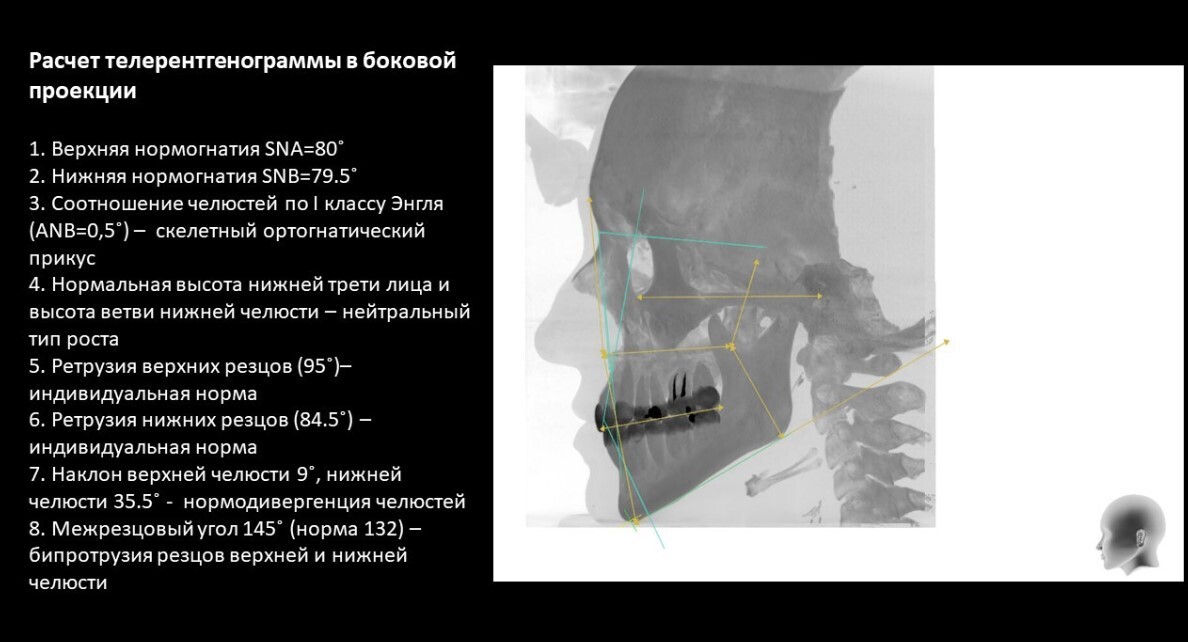 Цифровое планирование в ортодонтии: как современные технологии помогают добиваться идеального результата - 11