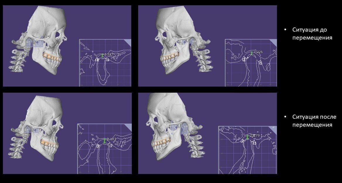 Исправили положение челюсти в компьютерной программе - теперь нужно исправить у пациентки.