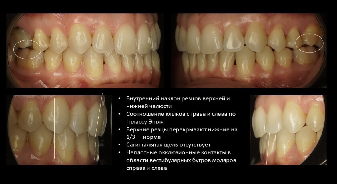 Неполное смыкание зубов.