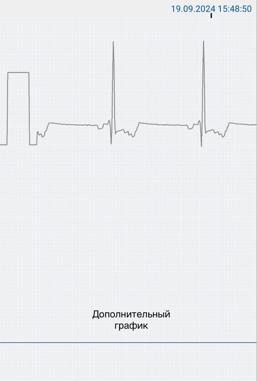 На скриншоте представлен дополнительный график. Его движение синхронизировано с графиком ЭКГ