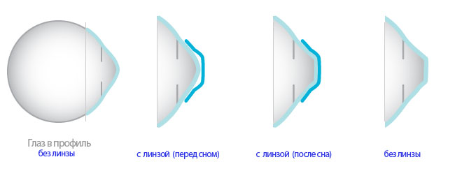 Безоперационная коррекция зрения. Ортокератология